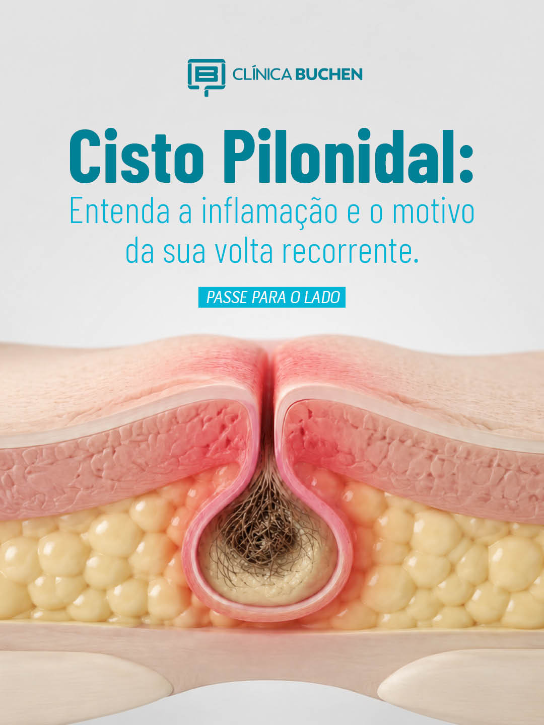 Cisto Pilonidal: Entenda a inflama��o e o motivo da sua volta recorrente